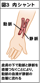 内シャント