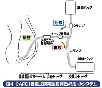 CAPD(持続式携帯型腹膜透析法)のシステム