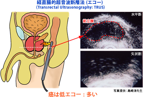 経直腸的超音波断層法