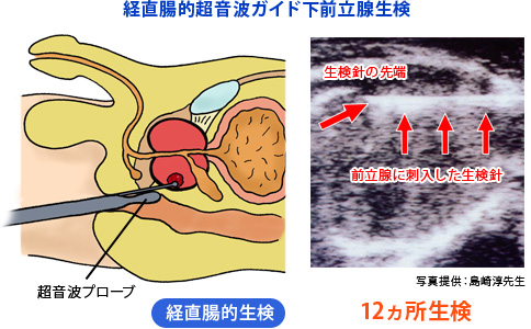 経直腸的超音波ガイド下前立腺生検