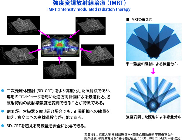 強度変調放射線治療（IMRT）
