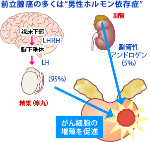 前立腺癌の多くは"男性ホルモン依存症"