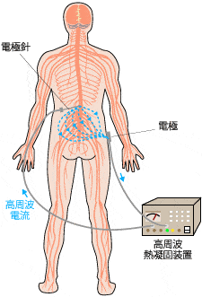 高周波熱凝固療法